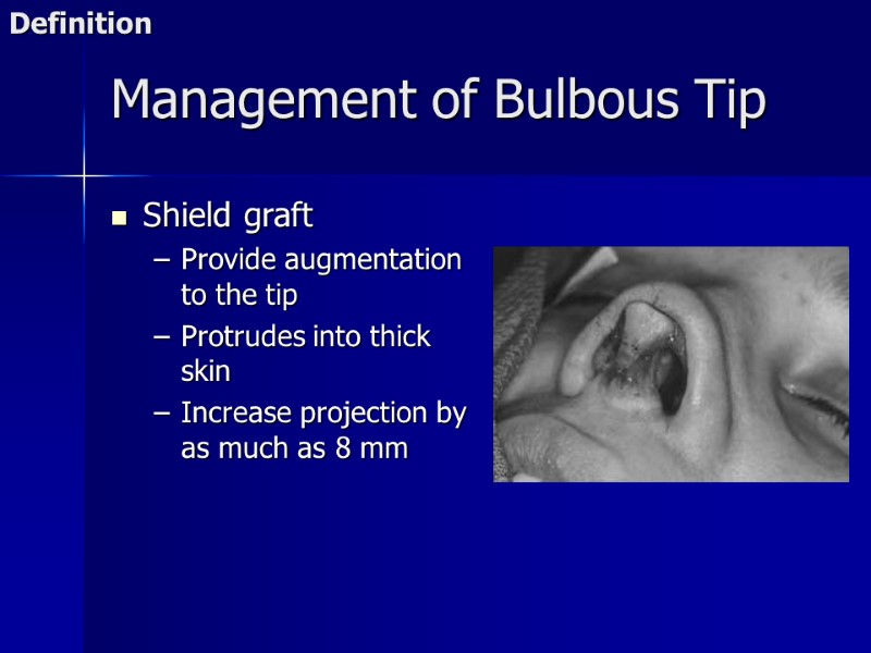 Management of Bulbous Tip Shield graft Provide augmentation to the tip Protrudes into thick